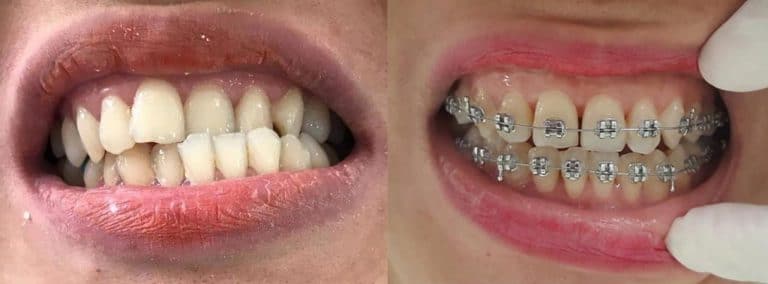 niềng răng Đà Nẵng niềng răng Đà Nẵng