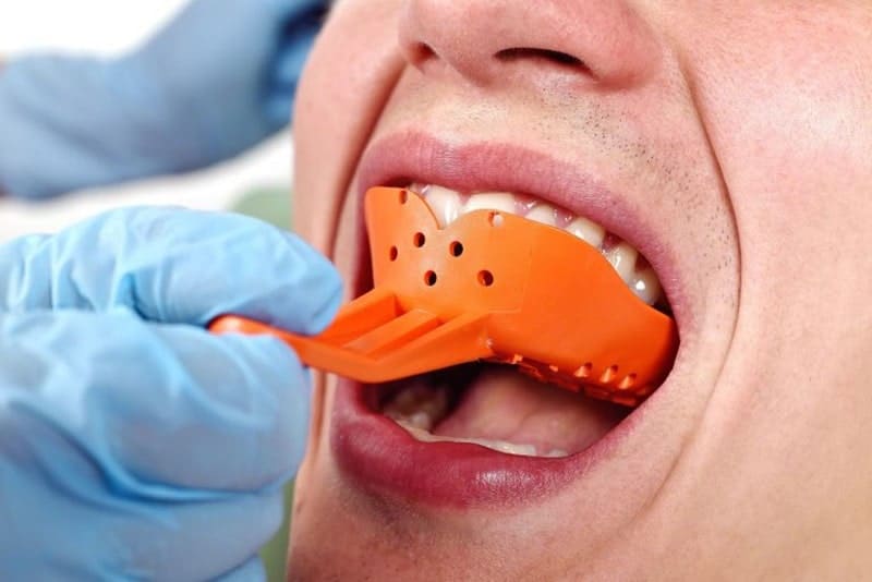 bọc răng sứ Đà Nẵng Trung Tâm Nha Khoa Thẩm Mỹ Đà Nẵng