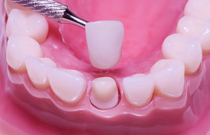 bọc răng sứ Đà Nẵng Nha Khoa Đại Nam