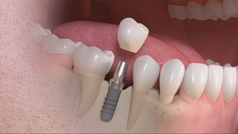 trồng răng implant Đà Nẵng