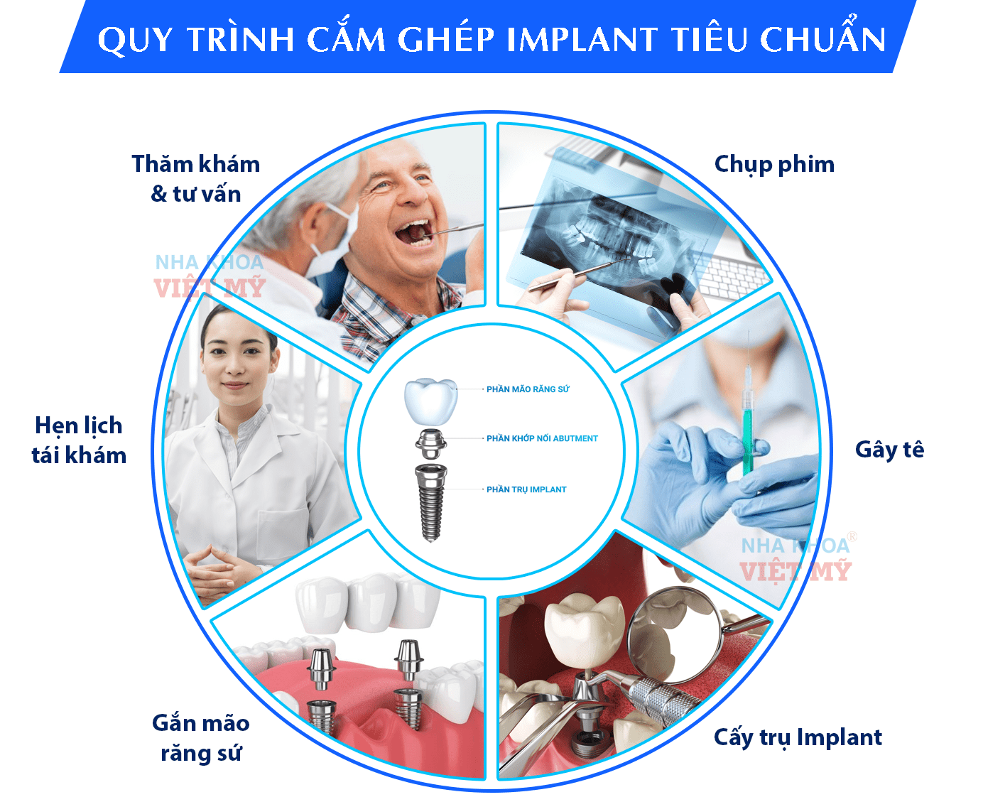 trồng răng implant Đà Nẵng
