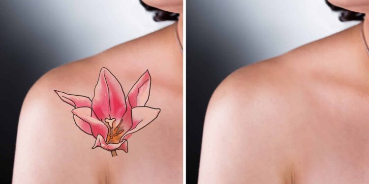 Tham Khảo Top 7 Địa Chỉ Xóa Xăm Đà Nẵng Chất Lượng Nhất