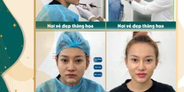 Thẩm Mỹ Anchee Clinic – Tiêm Môi Baby An Toàn, Phom Chuẩn