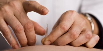 châm cứu tại nhà đà nẵng