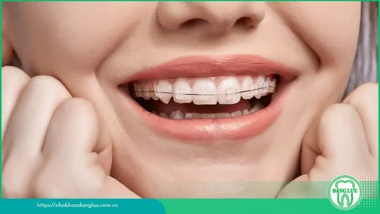 Nha khoa Đăng Lưu cung cấp dịch vụ niềng răng chất lượng