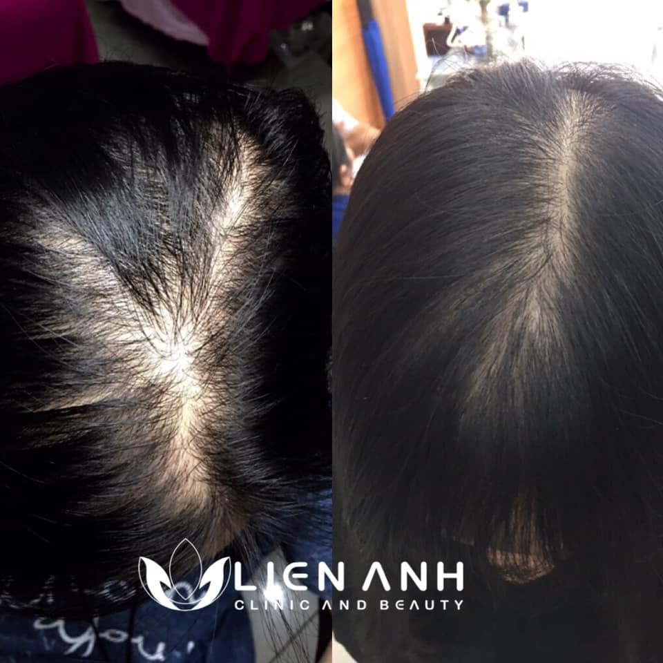 cấy tóc tự thân Đà Nẵng