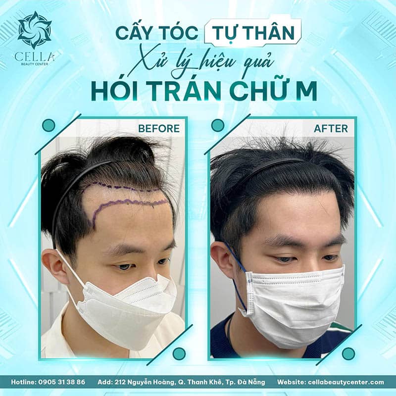 Viện Cấy Tóc Đà Nẵng Cella