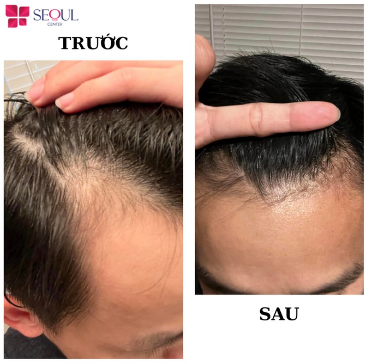 cấy tóc tự thân Đà Nẵng
