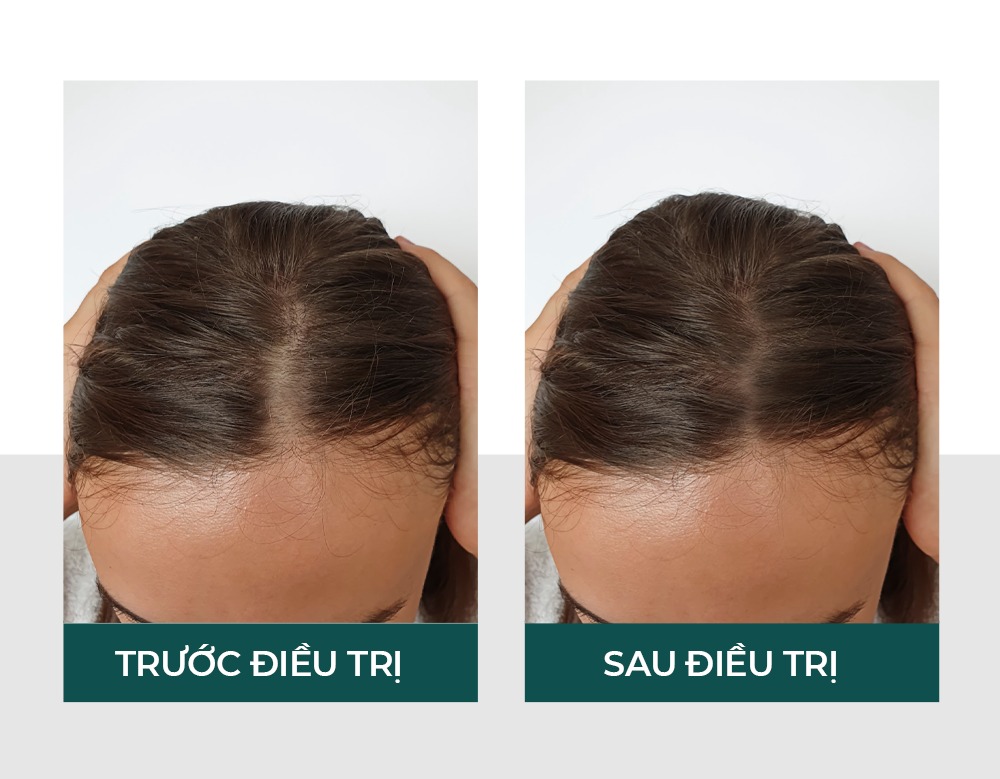 cấy tóc tự thân Đà Nẵng