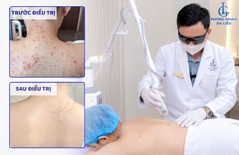 Công nghệ Acthyderm CO2 mang tới hiệu quả vượt trội và lâu dài